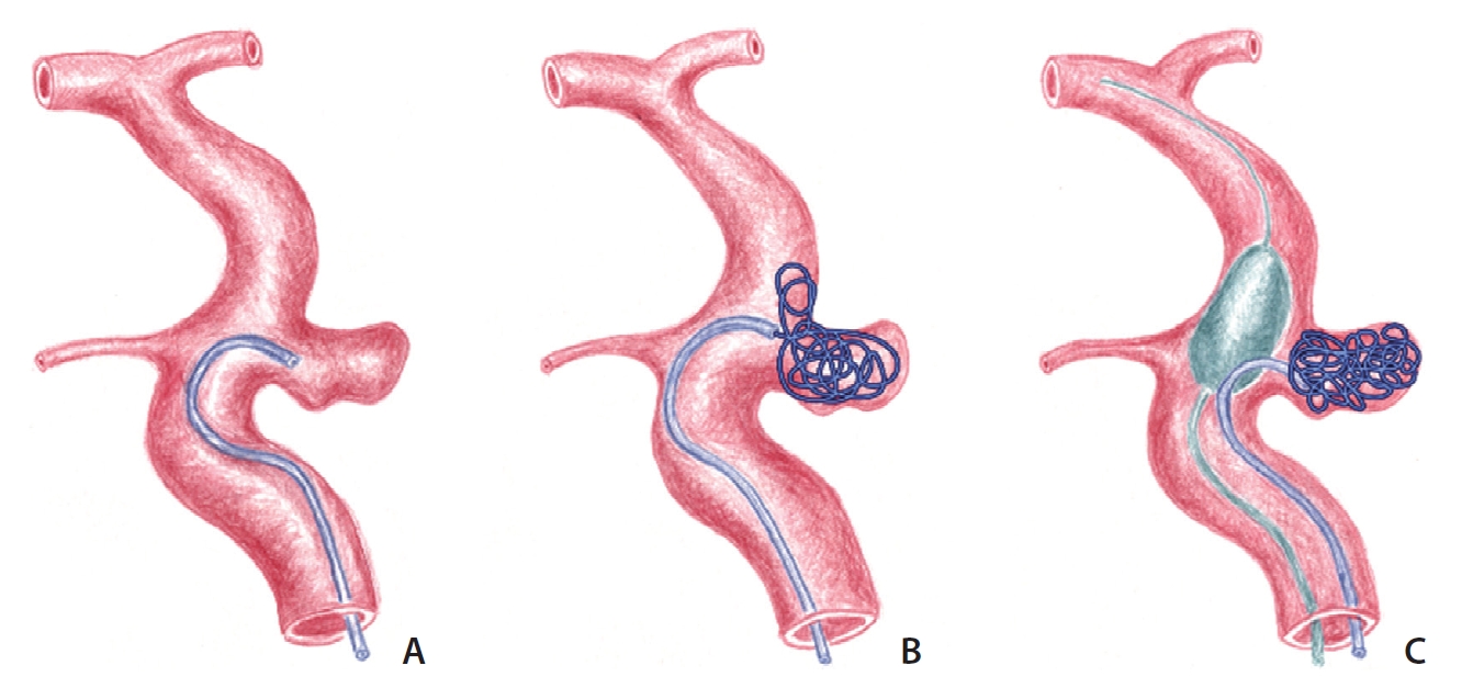 Aneurysm coiling/balloon assisted/ stent assisted coiling