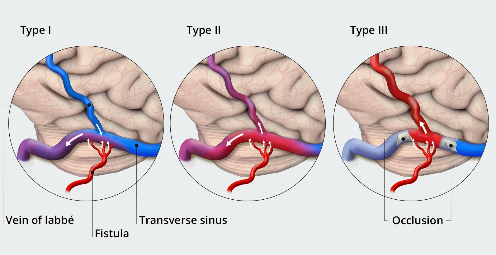AV Fistula embolization