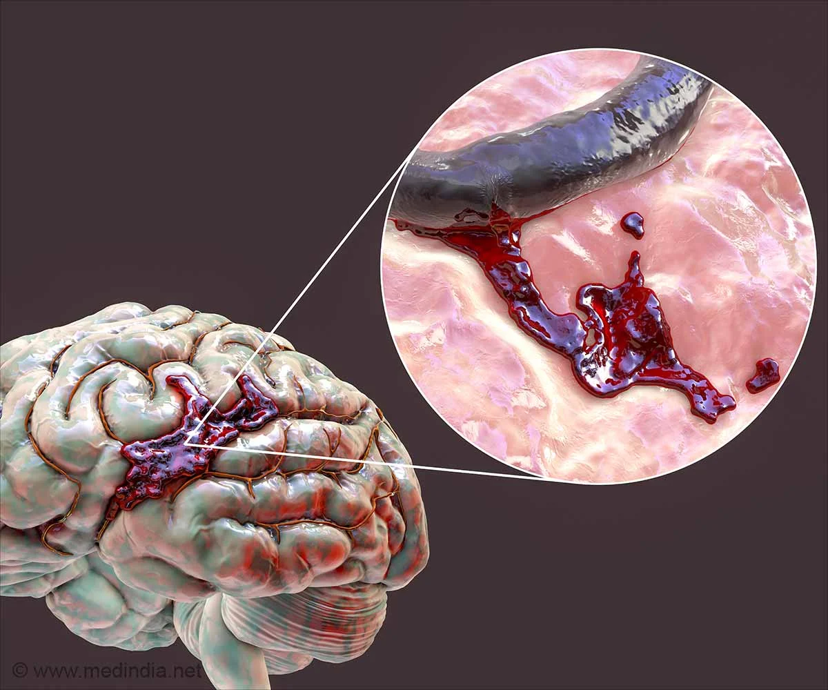 Brain Hemorrhage Surgery