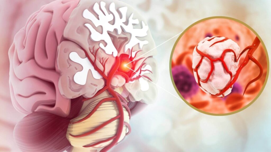 Brain Tumour embolization