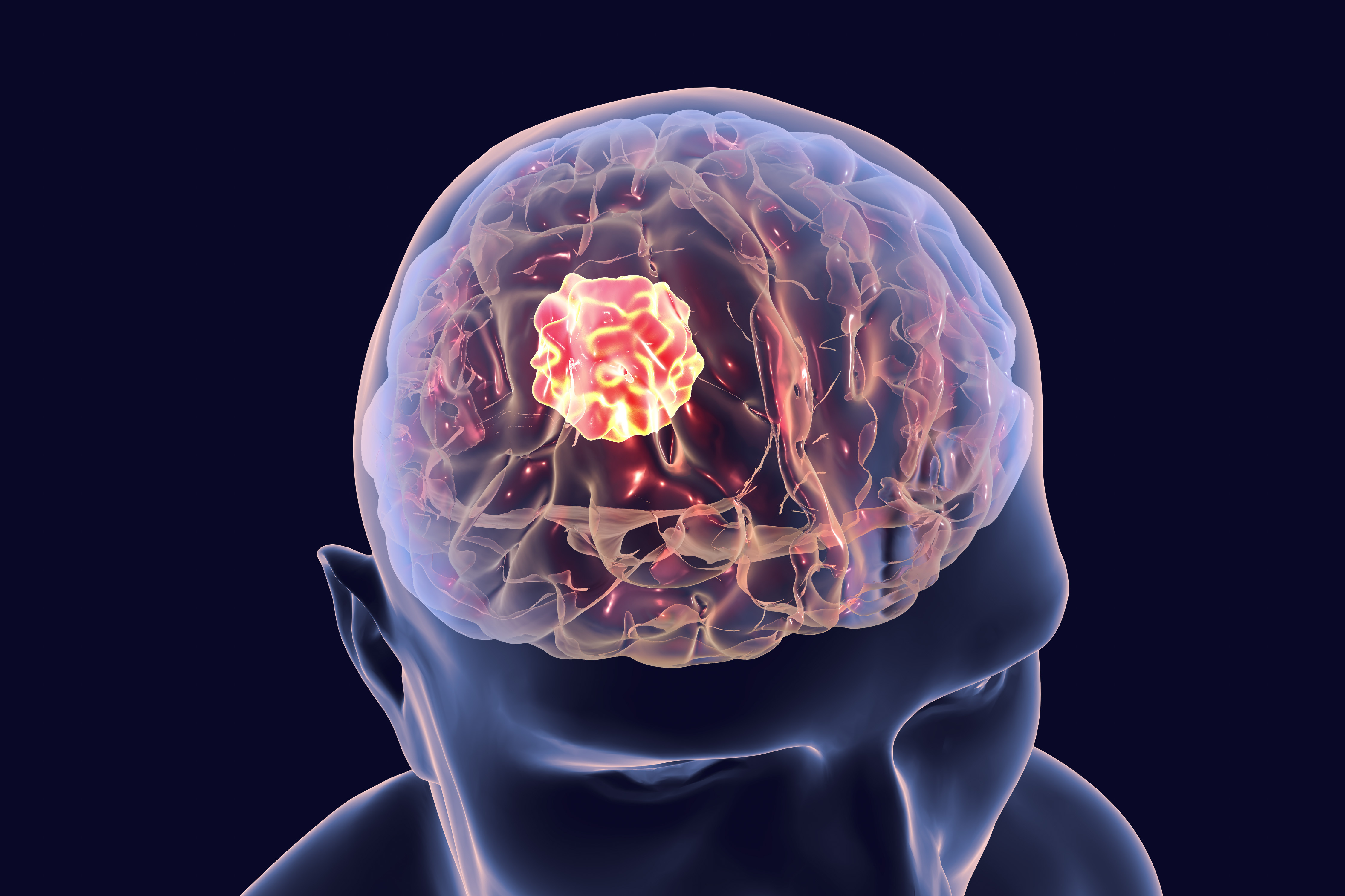 Brain Tumour Surgery
