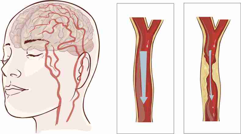 Flow diversion for giant aneurysms