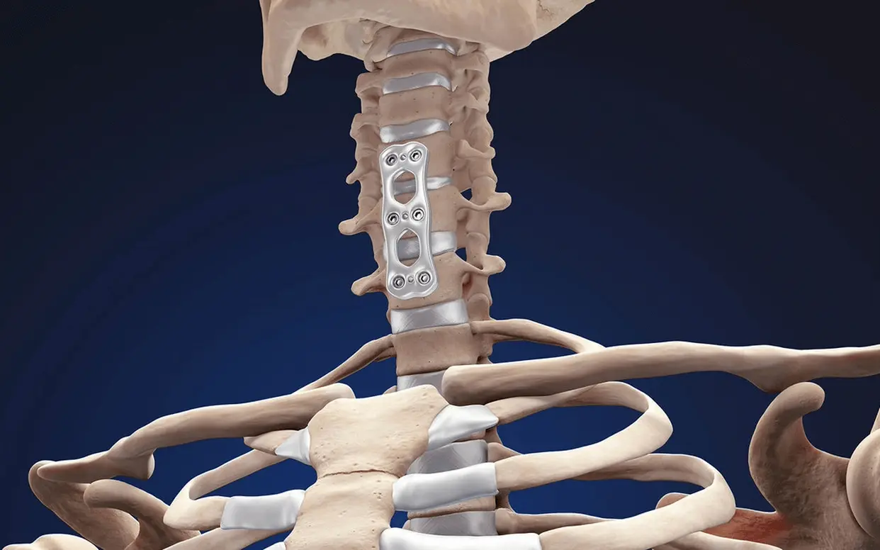 Discectomy and Fusion