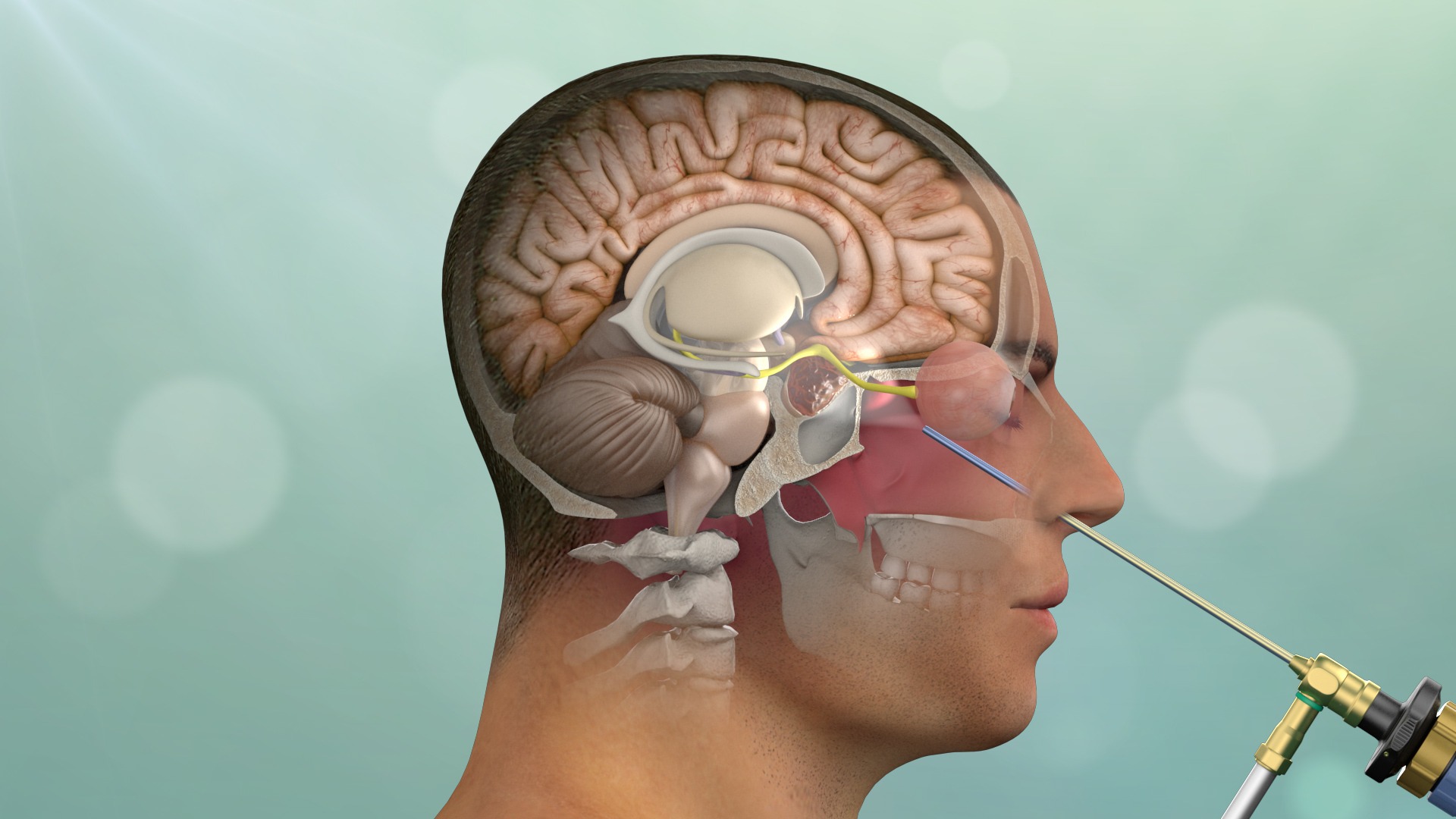 Endoscopic Brain Surgery