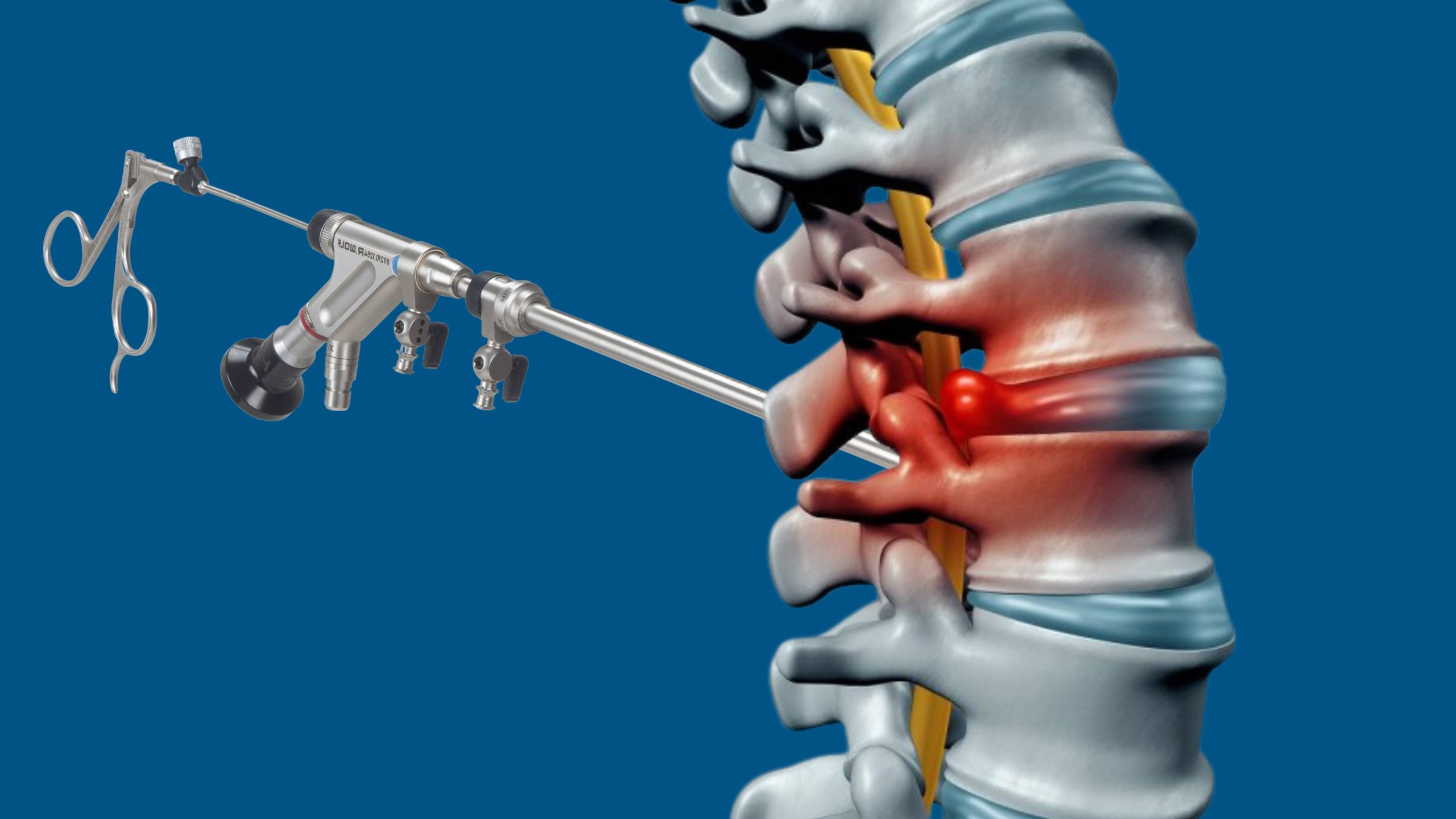 Endoscopic Spine Surgery