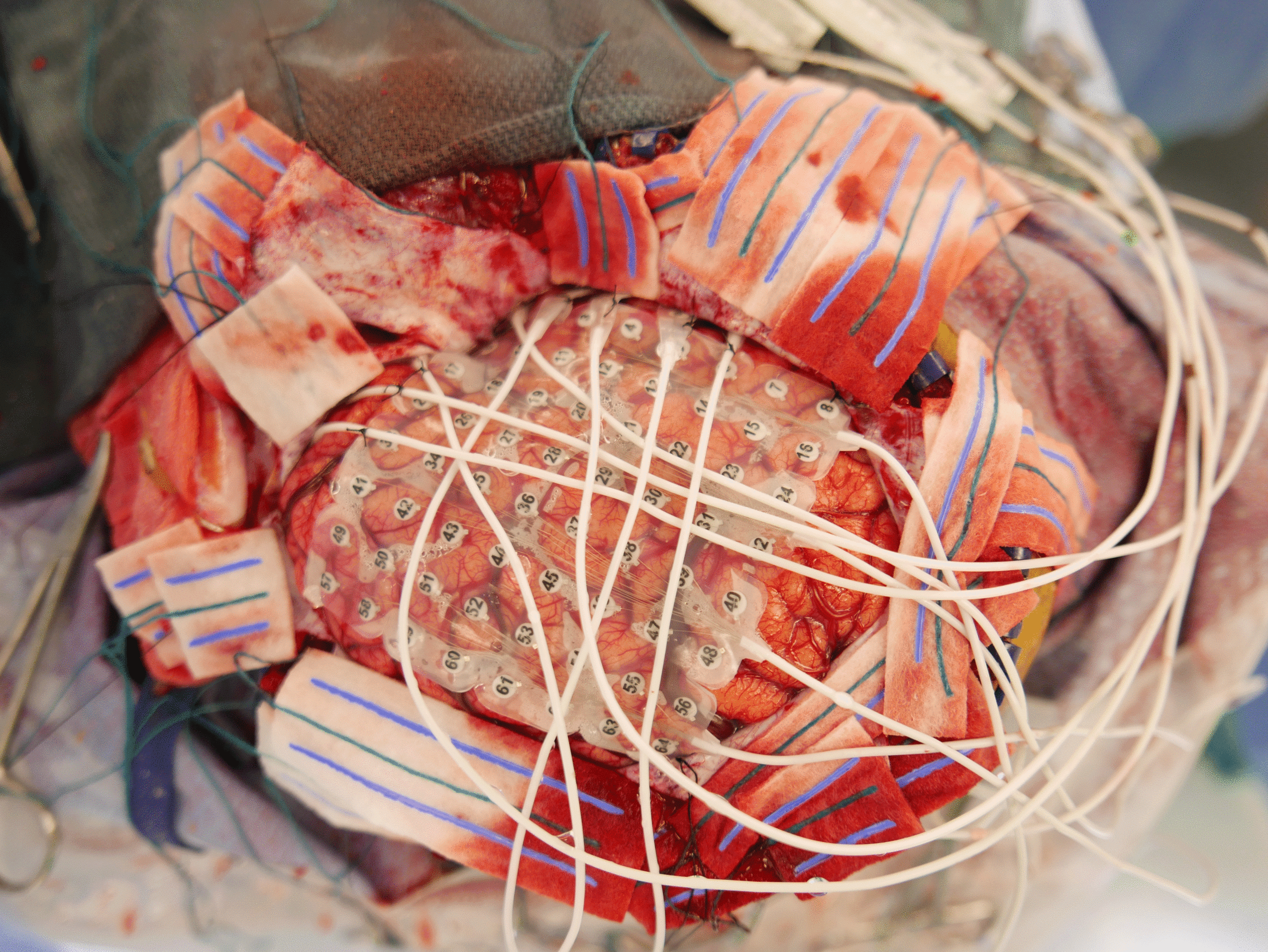 Epilepsy Surgery