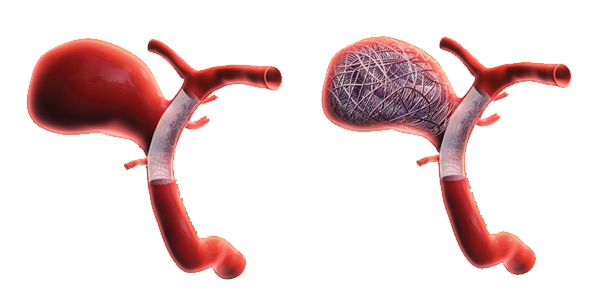 Flow diversion for giant aneurysms