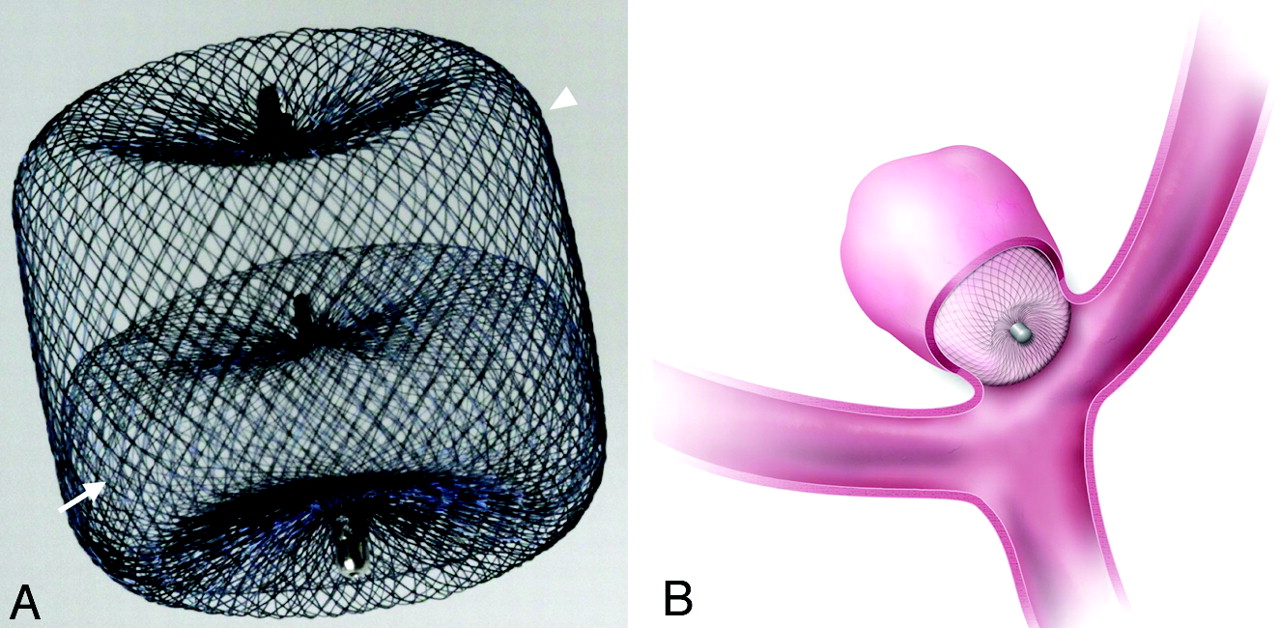 Intrasaccular device placements