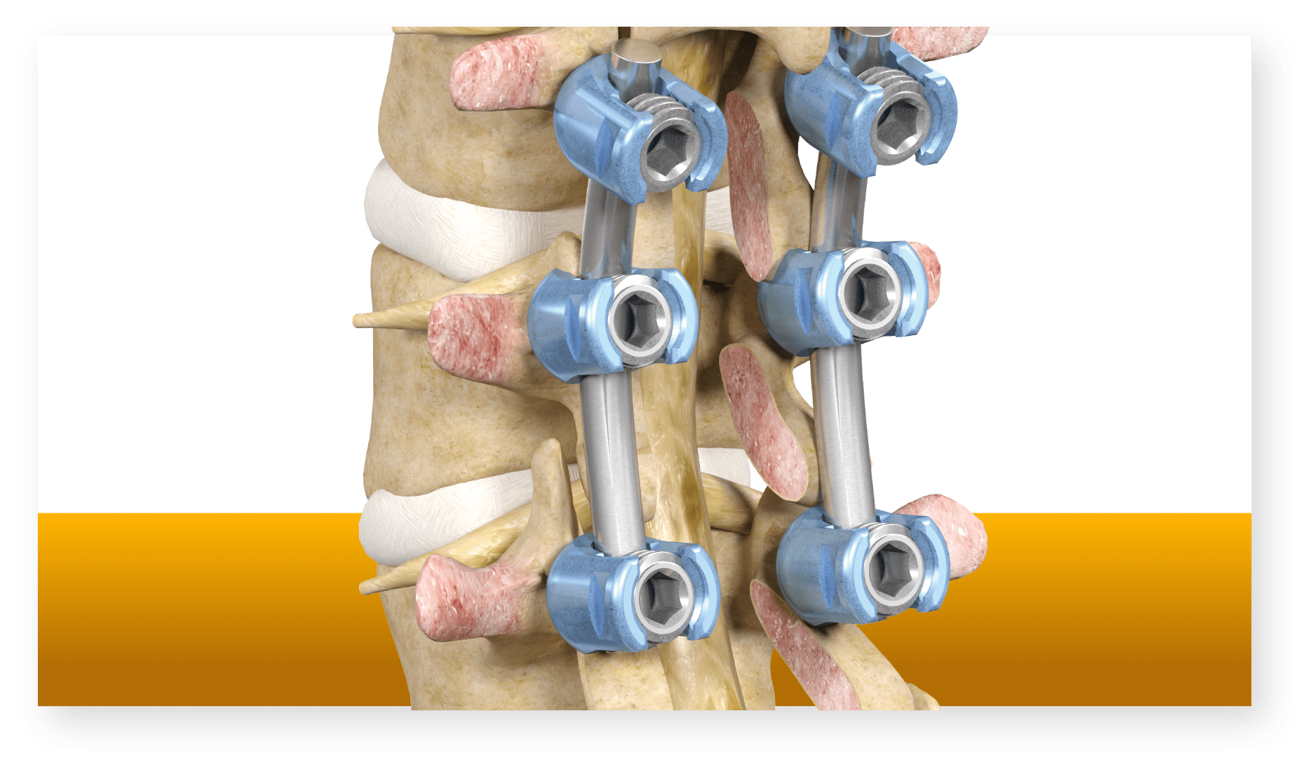 Lumbar Laminectomy