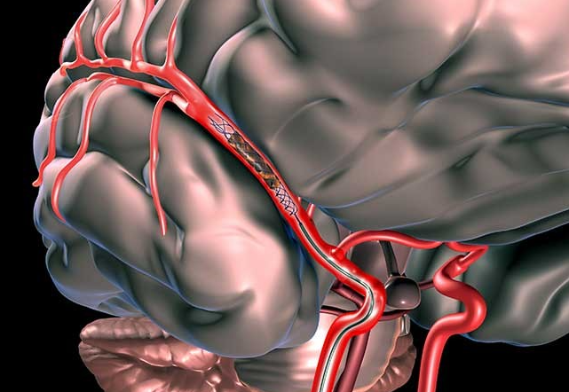 Mechanical Thrombectomy for Stroke