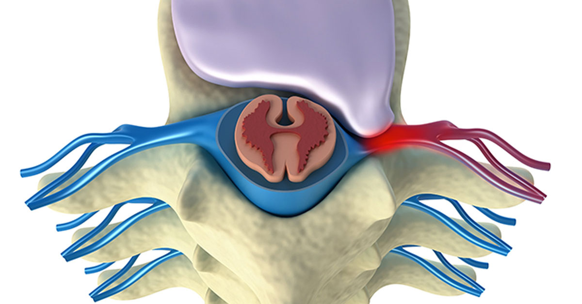 Microdiscectomy