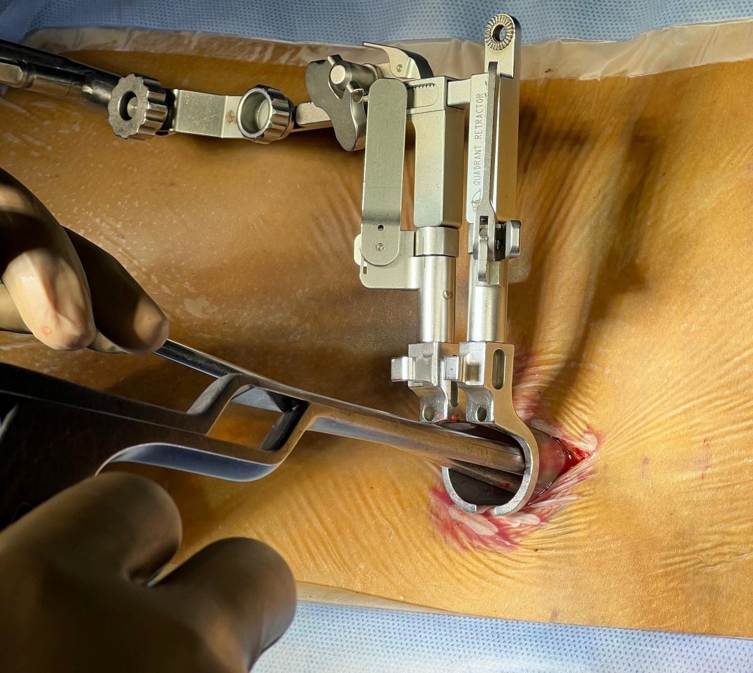 Discectomy and Fusion