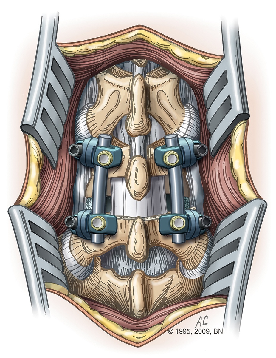 Spinal Fusion