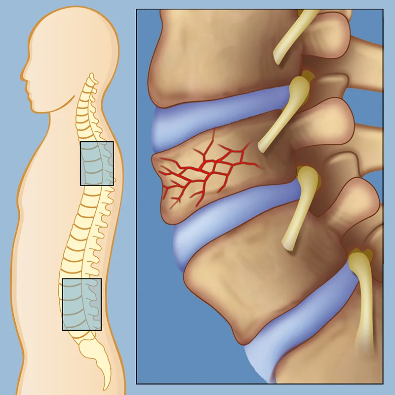 Spine Fixation for Fractures